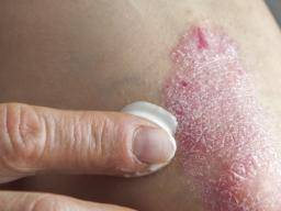 Psoriasis: possible topical treatments